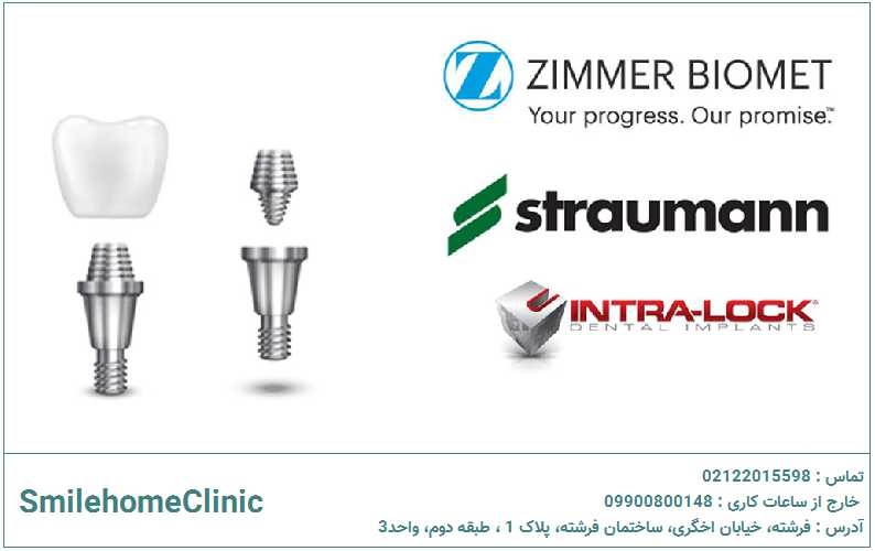 انتخاب برند ایمپلنت چه گزینههایی رایج است؟