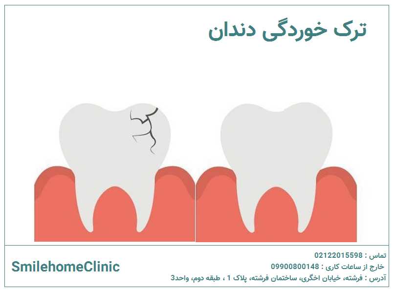 ترک خوردگی دندان