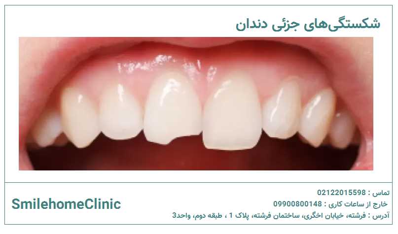 ترمیم شکستگی جزئی لمینت و کامپوزیت