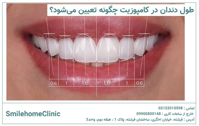 طول دندان در کامپوزیت چگونه تعیین می‌شود؟