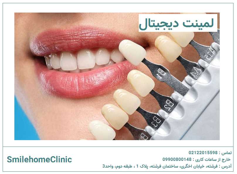 لمینت دیجیتال