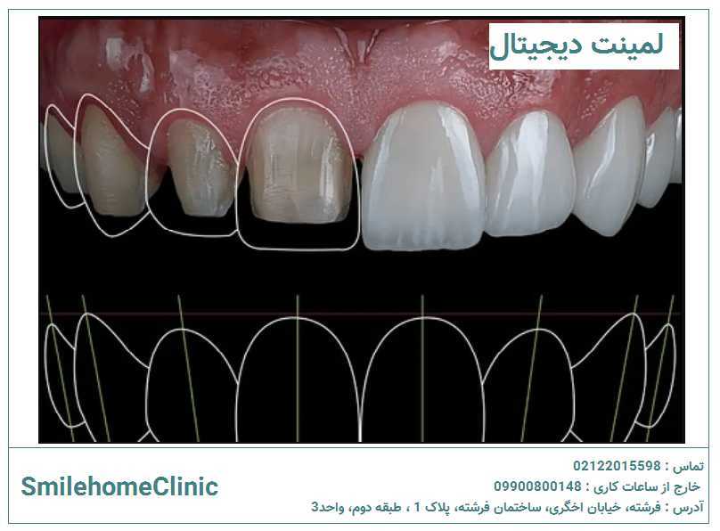 ایا لمینت دیجیتال برای همه مناسب است