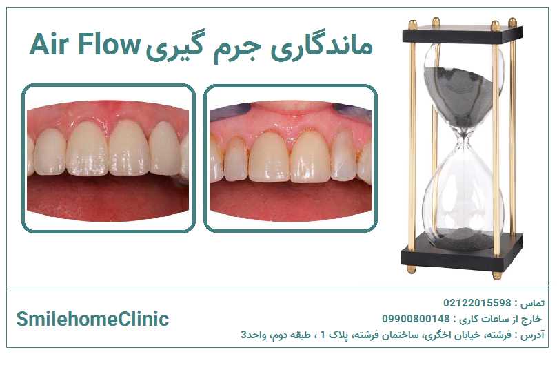 ماندگاری نتیجه جرم‌گیری در Air Flow و اولتراسونیک