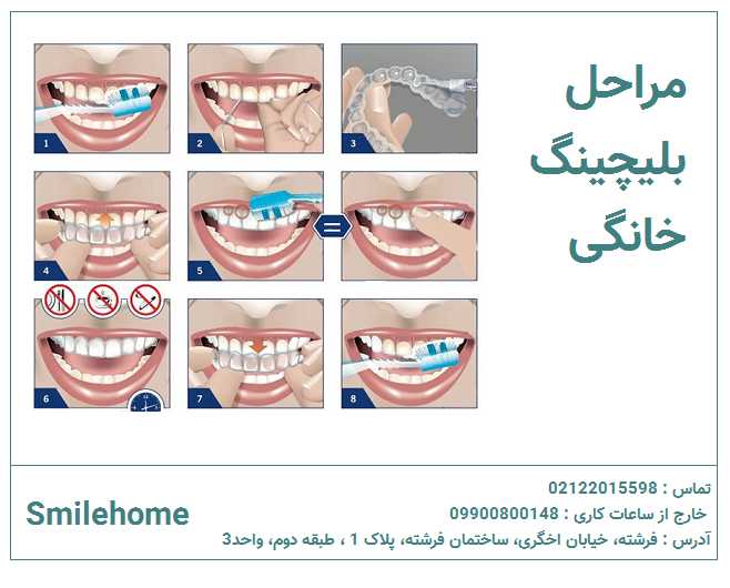 مراحل بلیچینگ
 دندان