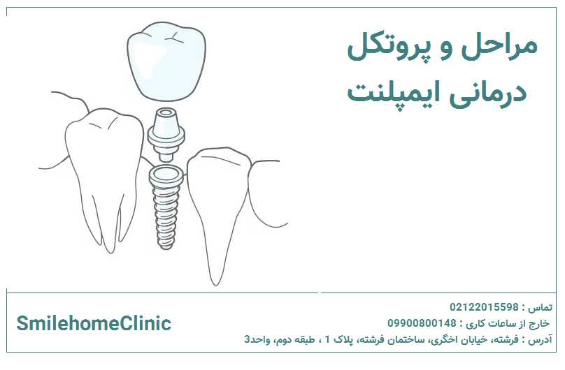 مراحل و پروتکل درمانی ایمپلنت