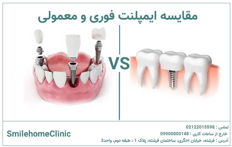 ایمپلنت فوری یا تأخیری