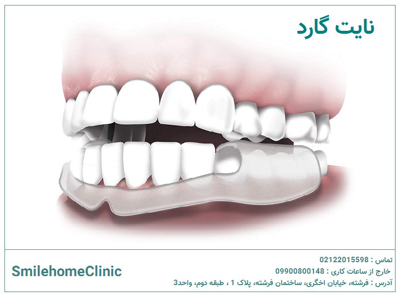 نایت‌گارد دندان