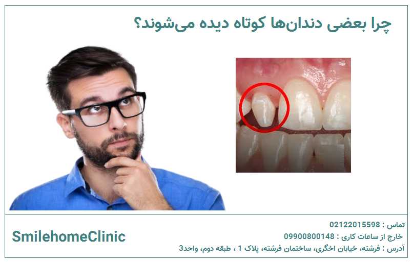چرا بعضی دندان‌ها کوتاه دیده می‌شوند؟