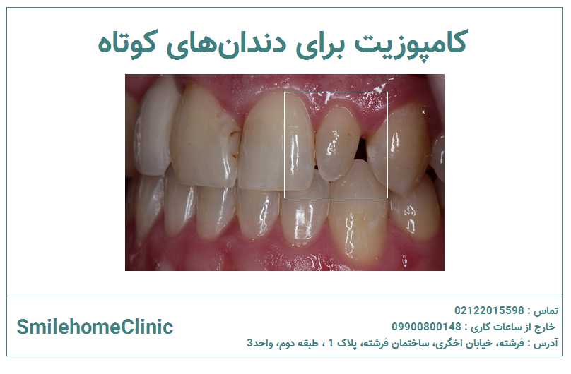 کامپوزیت برای دندان‌های کوتاه