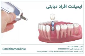 ایمپلنت برای افراد دیابتی